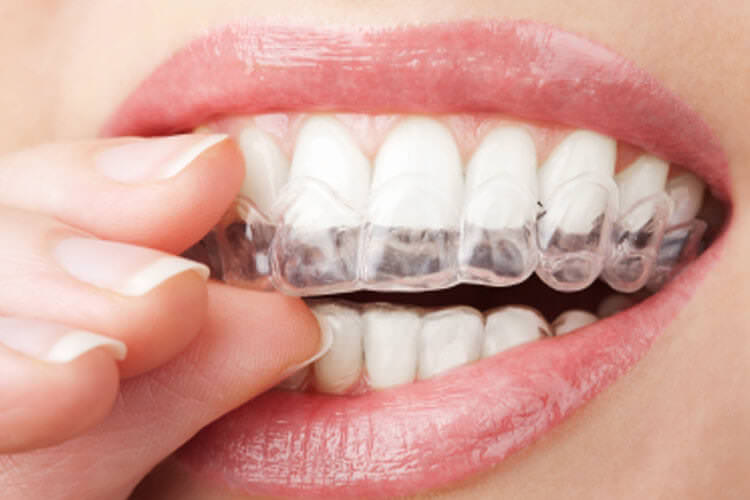 Invisalign