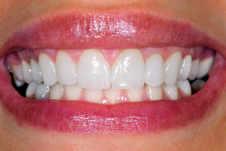 Veneers